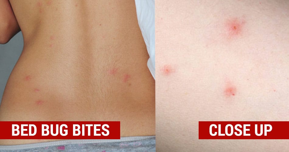 bed bug bites